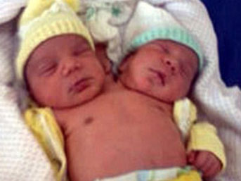 Brezilya’da çift başlı doğan erkek bebek şaşırtıyor