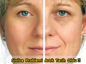 Sivilce Problemi Artık Tarih Oldu